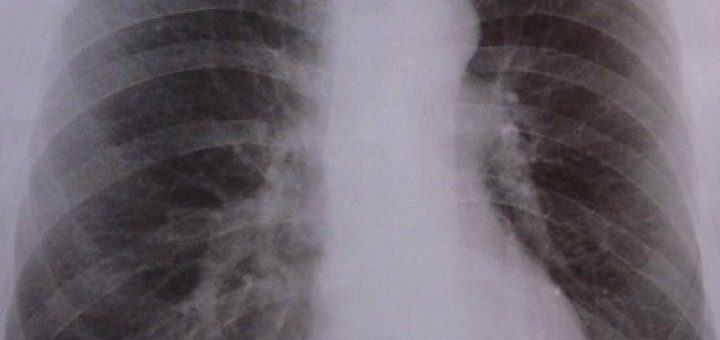 Röntgenbild flecken lunge weiße Vor längerer