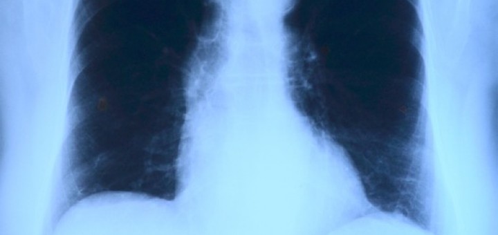 Röntgenbild, Brustkorb, Thorax, Lunge