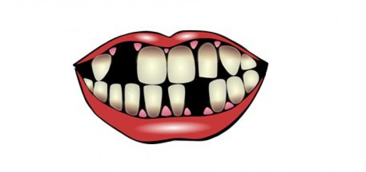 Zahnlücken im Mund